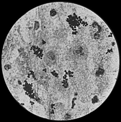 Fig. 2.—Staphylococcus aureus in Pus from case of Osteomyelitis.  1000 diam. Gram's stain.