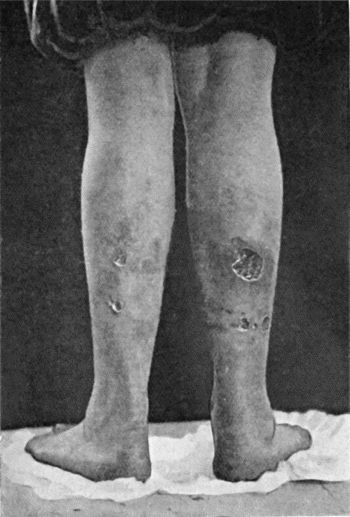 Fig. 16.—Bazin's Disease in a girl t.16.