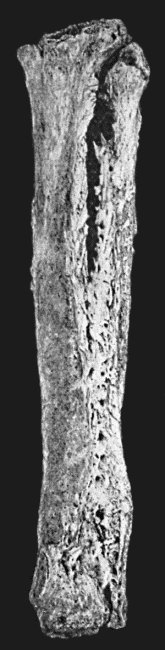 Fig. 19.—Tibia and Fibula, showing changes due to chronic ulcer of leg.