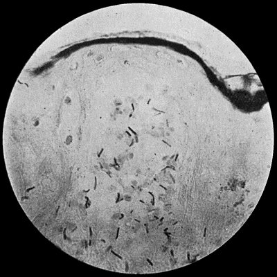 Fig. 27.—Bacillus of Anthrax in section of skin, from a case of malignant pustule; shows vesicle containing bacilli.  400 diam. Gram's stain.