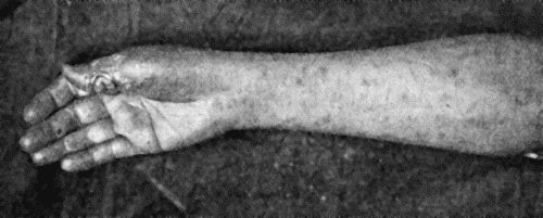 Fig. 38.—Primary Lesion on Thumb, with Secondary Eruption on Forearm.