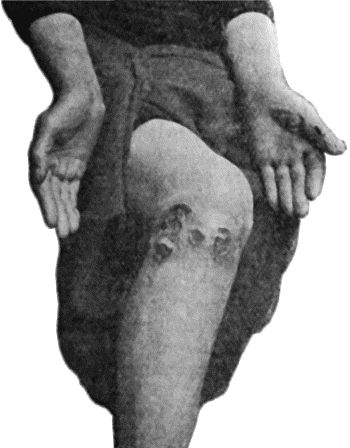 Fig. 42.—Tertiary Syphilitic Ulceration in region of Knee and on both Thumbs of woman t.37.