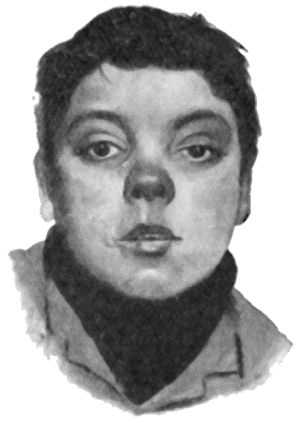 Fig. 43.—Facies of Inherited Syphilis.  (From Dr. Byrom Bramwell's Atlas of Clinical Medicine.)