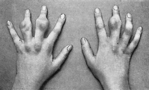 Fig. 48.—Zanthoma of Hands in a girl æt. 14, showing multiple subcutaneous tumours (cf. Fig. 49). (Sir H.J. Stiles' case.)