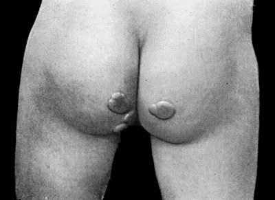 Fig. 49.—Zanthoma showing Subcutaneous Tumours on Buttocks. From same patient as Fig. 48.
