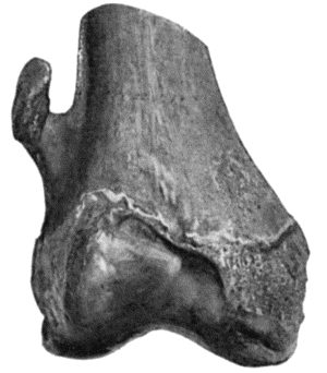 Fig. 52.—Cancellous Osteoma of lower end of Femur.