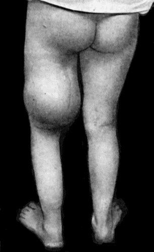 Fig. 55.—Recurrent Sarcoma of Sciatic Nerve in a woman t.27. Recurrence twenty months after removal of primary growth.