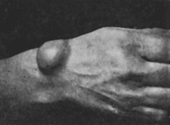 Fig. 60.—Carpal Ganglion in a woman t.25.