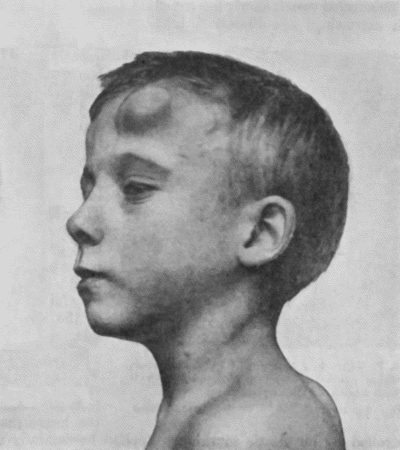 Fig. 69.—Cirsoid Aneurysm of Forehead in a boy t.10. (Mr. J.W. Dowden's case.)