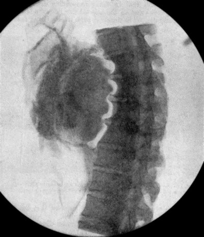 Fig. 71.—Radiogram of Aneurysm of Aorta, showing laminated clot and erosion of bodies of vertebr. The intervertebral discs are intact.