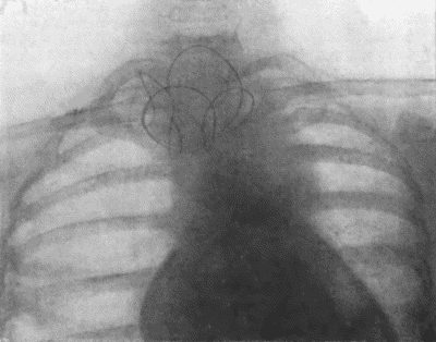 Fig. 73.—Radiogram of Innominate Aneurysm after treatment by the Moore-Corradi method. Two feet of finely drawn silver wire were introduced. The patient, a woman, t.47, lived for ten months after operation, free from pain (cf. Fig. 75).