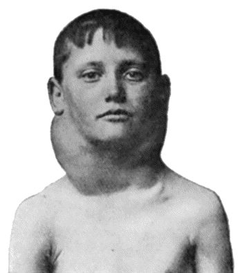 Fig. 80.—Chronic Hodgkin's Disease in a boy t.11.