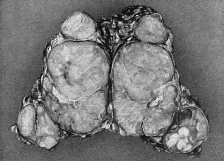 Fig. 82.Lympho-Sarcoma removed from Groin. It will be observed that there is one large central parent tumour surrounded by satellites.