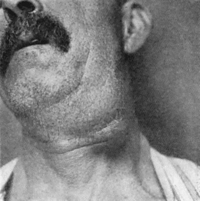Fig. 83.Cancerous Glands in Neck secondary to Epithelioma of Lip. (Mr. G.L. Chiene's case.)