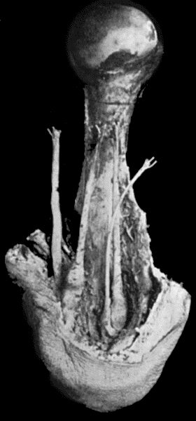 Fig. 85.Amputation Stump of Upper Arm, showing bulbous thickening of the ends of the nerves, embedded in scar tissue at the apex of the stamp.