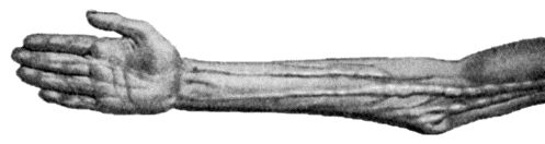 Fig. 86.Diffuse enlargement of Nerves in generalised Neuro-fibromatosis. (After R.W. Smith.)