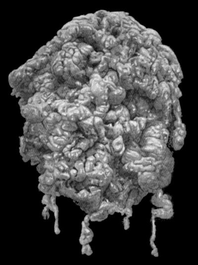 Fig. 87.Plexiform Neuroma of small Sciatic Nerve, from a girl t.16. (Mr. Annandale's case.)