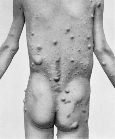 Fig. 88.Multiple Neuro-fibromas of Skin (Molluscum fibrosum, or Recklinghausen's disease).