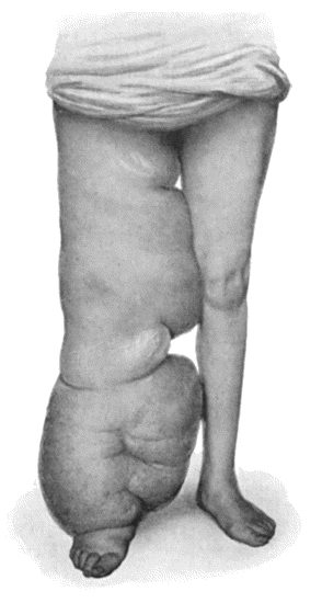 Fig. 89.—Elephantiasis Neuromatosa in a woman t.28