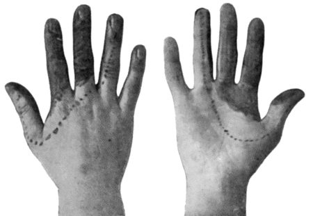 Fig. 91.To illustrate the Loss of Sensation produced by Division of the Median Nerve. The area of complete cutaneous insensibility is shaded black. The parts insensitive to light touch and to intermediate degrees of temperature are enclosed within the dotted line. (After Head and Sherren.)
