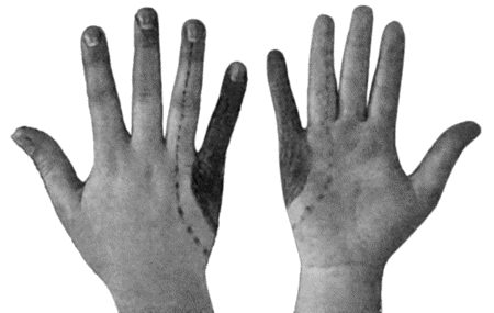 Fig. 92.To illustrate Loss of Sensation produced by complete Division of Ulnar Nerve. Loss of all forms of cutaneous sensibility is represented by the shaded area. The parts insensitive to light touch and to intermediate degrees of heat and cold are enclosed within the dotted line. (Head and Sherren.)