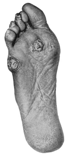 Fig. 93.Callosities and Corns on the Sole and Plantar Aspect of the Toes in a woman who was also the subject of flat-foot.