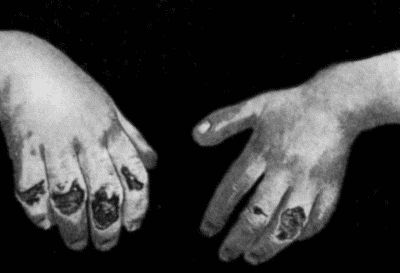 Fig. 94.Ulcerated Chilblains on Fingers of a Child.