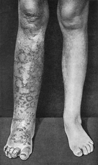 Fig. 96.—Tuberculous Elephantiasis in a woman t.35.
