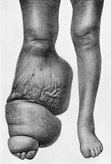 Fig. 97.Elephantiasis in a woman t.45.