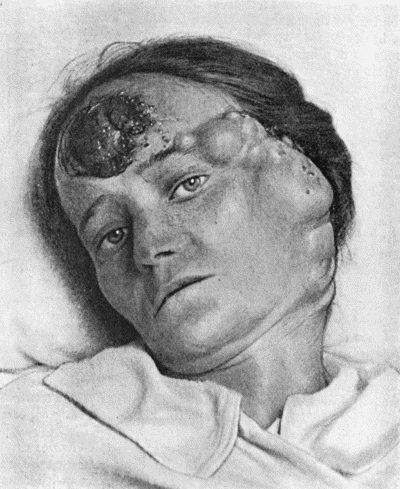 Fig. 105.Melanotic Cancer of Forehead with Metastases in Lymph Vessels and Glands.
