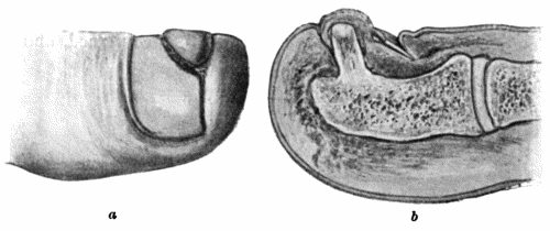 Fig. 107.Subungual Exostosis growing from Distal Phalanx of Great Toe, showing Ulceration of Skin and Displacement of Nail. a. Surface view. b. On section.