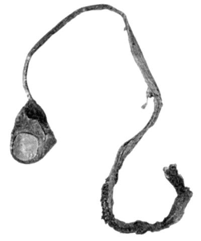 Fig. 108.Avulsion of Tendon with Terminal Phalanx of Thumb. (Surgical Museum, University of Edinburgh.)