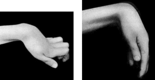 Fig. 109.—Volkmann's Ischmic Contracture. When the wrist is flexed to a right angle it is possible to extend the fingers. (Photographs lent by Mr. Lawford Knaggs)