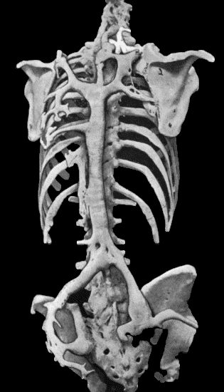 Fig. 112.Ossification in Muscles of Trunk in a case of generalised Ossifying Myositis. (Photograph lent by Dr. Rustomjee.)