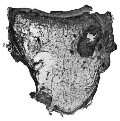 Fig. 124.—Tuberculous Osteomyelitis of Os Magnum, excised from a boy t.8. Note well-defined caseous focus, with several minute foci in surrounding marrow.