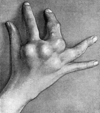 Fig. 142.—Multiple Chondromas of Phalanges and Metacarpals in a boy t.10 (cf. Fig. 143).