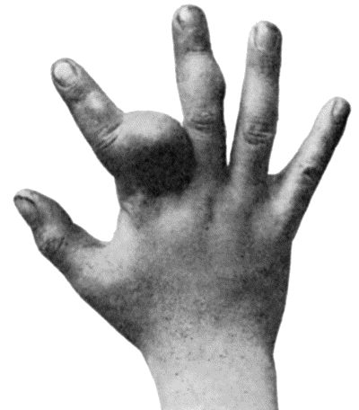Fig. 144.—Multiple Chondromas in Hand of boy t.8