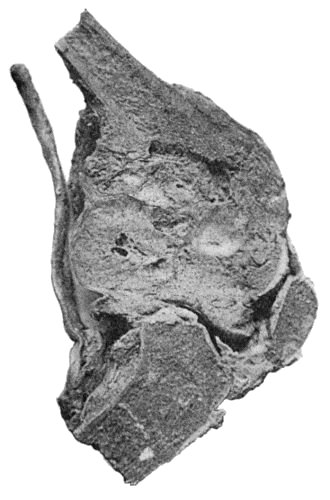 Fig. 149.—Central Sarcoma of Lower End of Femur, invading the knee-joint. (Museum of Royal College of Surgeons, Edinburgh.)