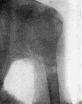Fig. 152.—Radiogram of Chondro-Sarcoma of Upper End of Humerus in a woman t.29.
