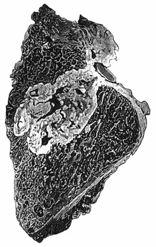 Fig. 156.—Section of Upper End of Fibula, showing caseating focus in marrow, erupting on articular surface and infecting joint.