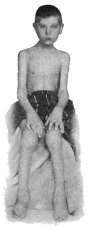 Fig. 161.—Arthritis Deformans affecting several Joints, in a boy t.10.  (Dr. Dickson's case.)