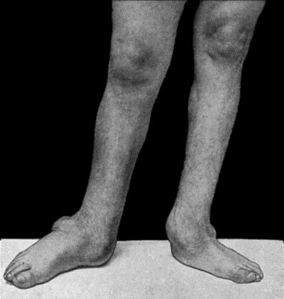 Fig. 164.—Charcot's Disease of both Ankles: front view. Man, t.32.