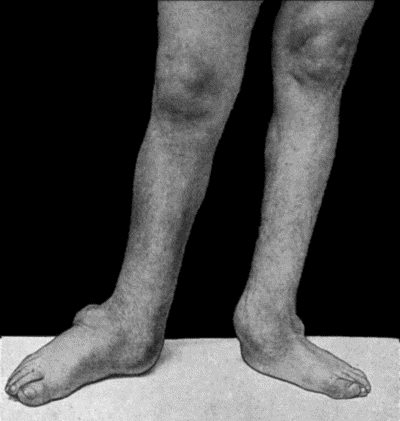 Fig. 164.—Charcot's Disease of both Ankles: front view. Man, t.32.