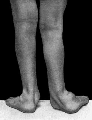 Fig. 165.—Charcot's Disease of both Ankles: back view. Man, t.32.