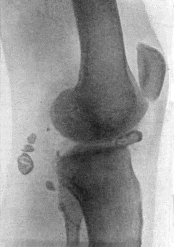 Fig. 166.—Radiogram of Multiple Loose Bodies in Knee-joint and Semi-membranosus Bursa in a man t.38. (Mr. J.W. Dowden's case.)