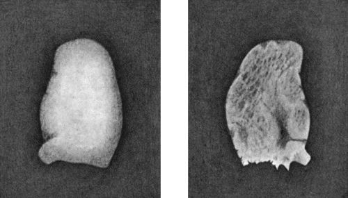 Fig. 167.—Loose Body from Knee-joint of man t.25. Natural size. a=Convex surface. b = Concave surface.