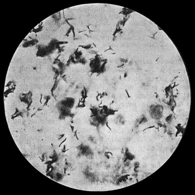 Fig. 33.—Tubercle Bacilli in caseous material  1000 diam. Z. Neilsen stain.